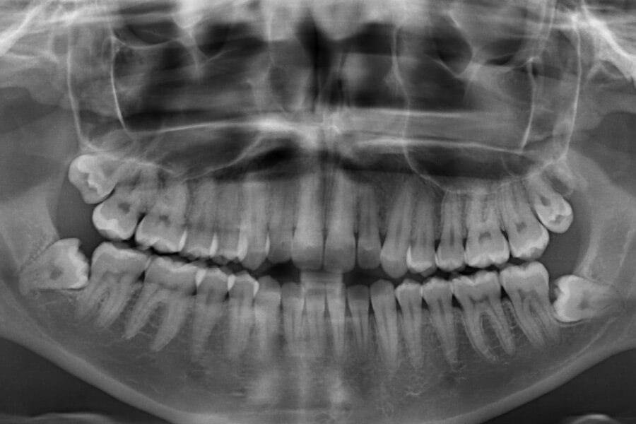 Black and white panoramic dental X-ray image of a patient's jaw and both teeth arches