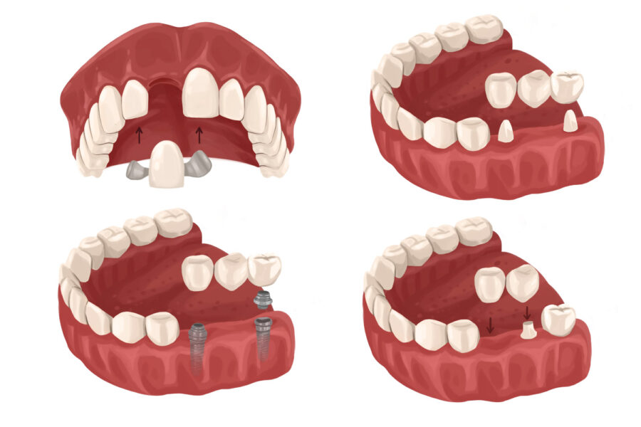 Drawings of different kinds of dental bridges to replace missing teeth