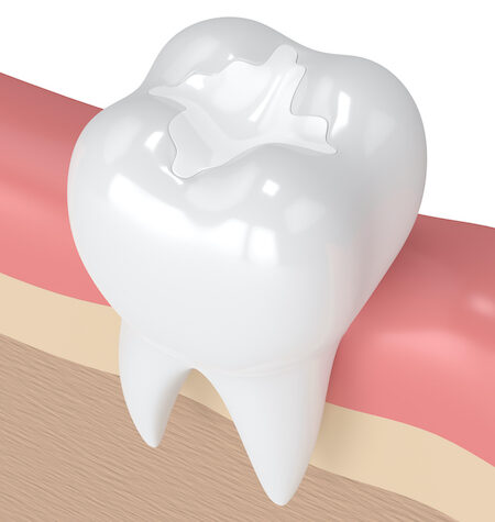 Closeup of a molar with a white dental sealant filling in its grooves